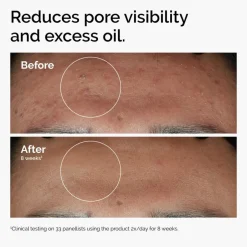 Niacinamide 10% + Zinc 1%-The Ordinary Sale